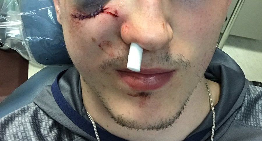 Zach Werenski&#39;s Face Is Really Fucked Up