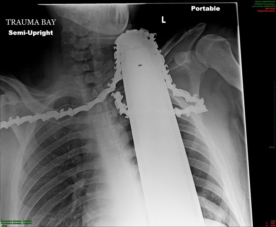 Man Takes Chainsaw To The Neck, Somehow Survives