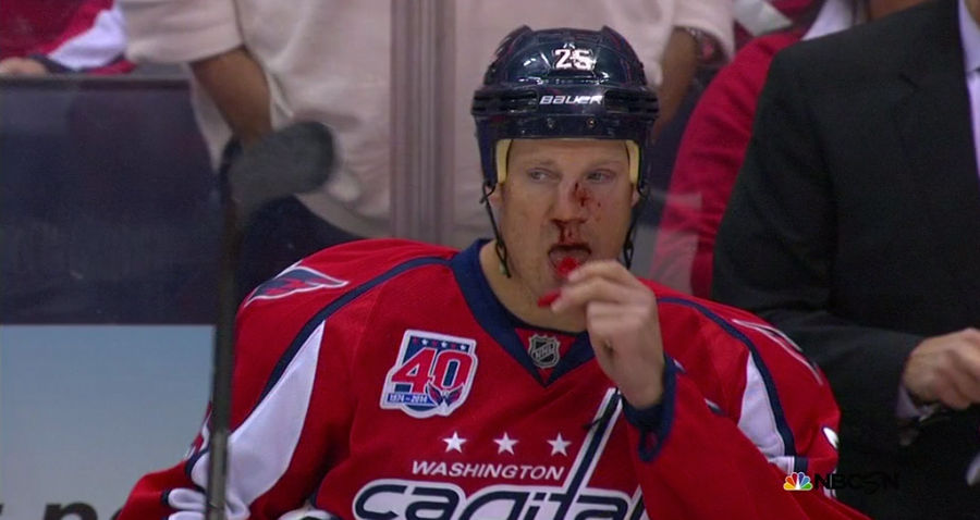 Jason Chimera&#39;s Nose Got Toasted Last Night