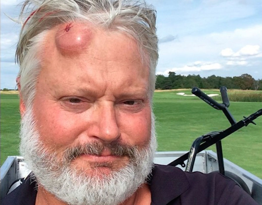 Man Hit In Head With Golf Ball, Has Golf-Ball-Sized Welt To Prove It