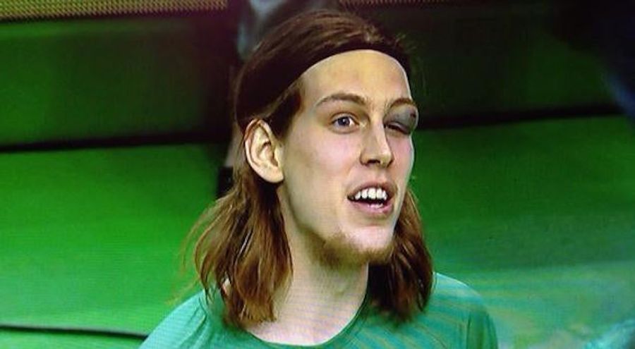 Kelly Olynyk&#39;s Eye Is Pretty Messed Up
