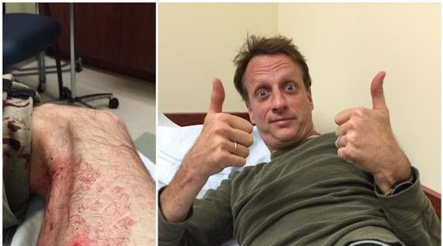 What Was This Thing Sticking Out Of Tony Hawk&#39;s Thigh?