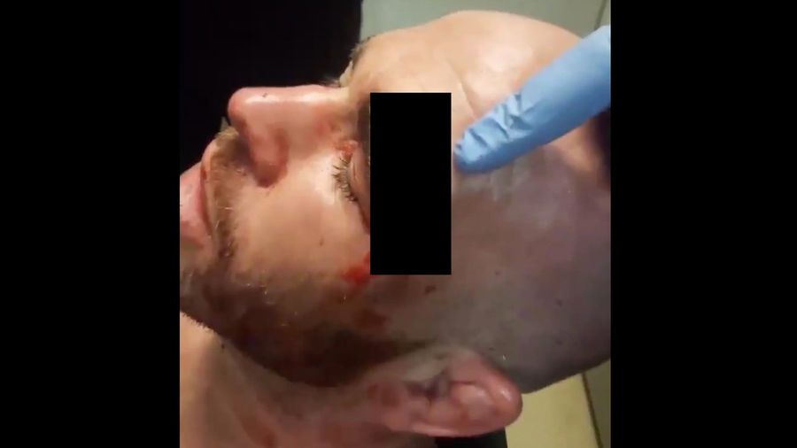 MMA Fighter Takes Knee To The Face, Suffers Extremely Gnarly Head Wound