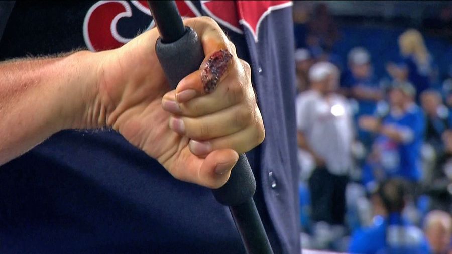 Trevor Bauer's Sliced Up Pinkie Is Extremely Gross