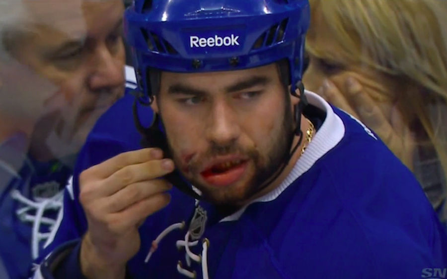 Roman Polak Messed Up By Slapshot To The Face