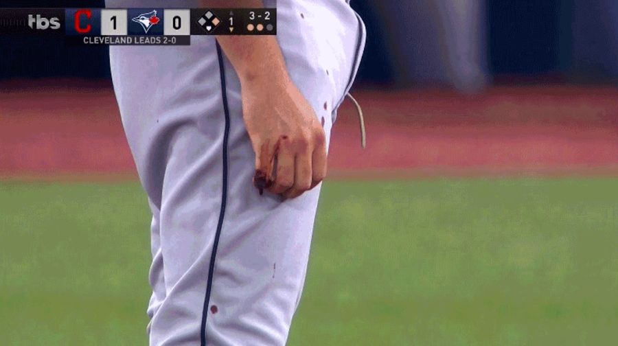 Trevor Bauer Considered Cauterizing His Gross Finger With A Soldering Iron